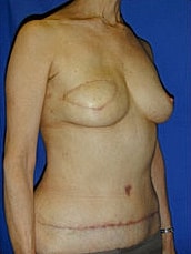 Breast Reconstruction Before & After