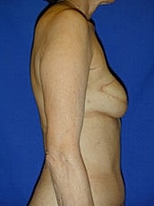 Breast Reconstruction Before & After