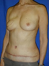 Breast Reconstruction Before & After