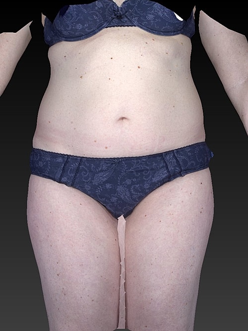 Liposuction Before & After