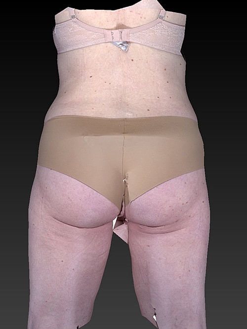 Liposuction Before & After