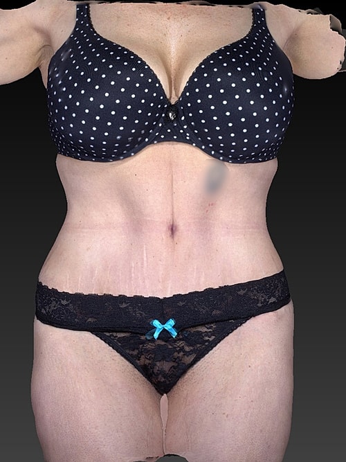 Liposuction Before & After