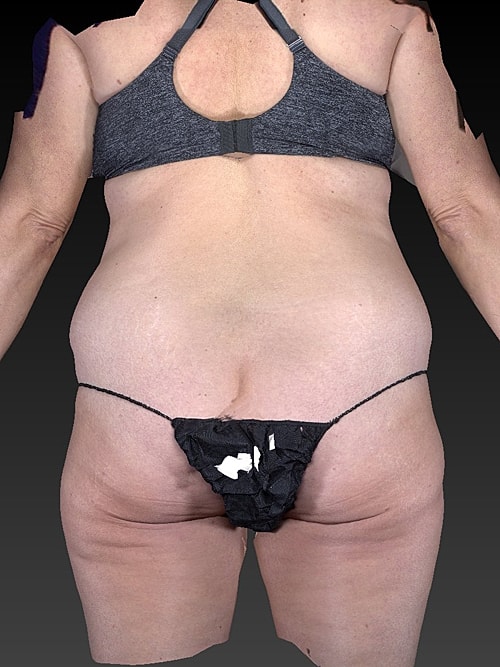 Liposuction Before & After