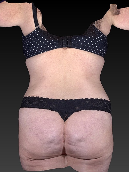 Liposuction Before & After