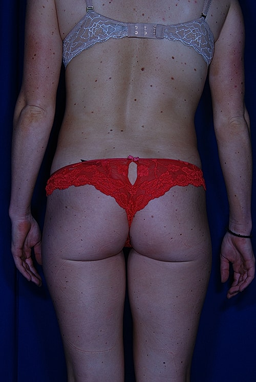 Liposuction Before & After