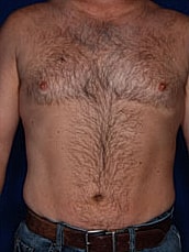Liposuction Before & After