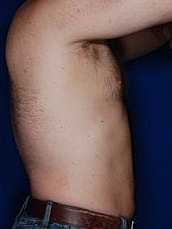 Liposuction Before & After