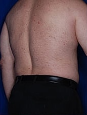 Liposuction Before & After