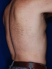Liposuction Before & After