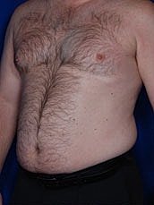 Liposuction Before & After