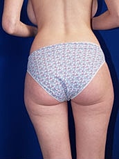 Liposuction Before & After