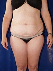 Liposuction Before & After