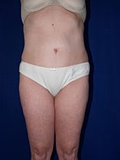 Liposuction Before & After