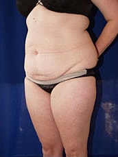 Liposuction Before & After