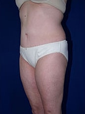 Liposuction Before & After