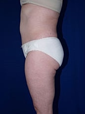 Liposuction Before & After