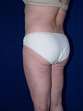 Liposuction Before & After