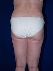 Liposuction Before & After