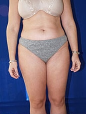 Liposuction Before & After