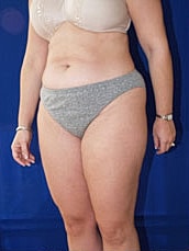 Liposuction Before & After