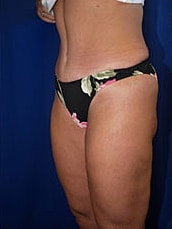 Liposuction Before & After