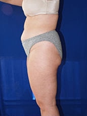 Liposuction Before & After