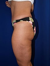 Liposuction Before & After