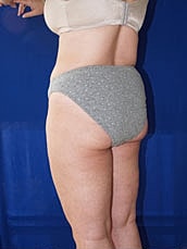 Liposuction Before & After