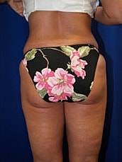 Liposuction Before & After