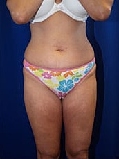 Liposuction Before & After
