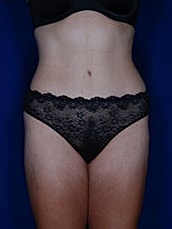 Liposuction Before & After