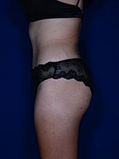 Liposuction Before & After