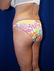 Liposuction Before & After
