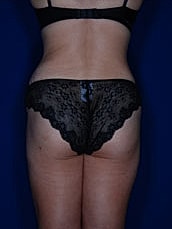 Liposuction Before & After