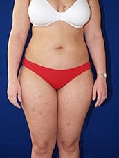 Liposuction Before & After