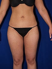 Liposuction Before & After