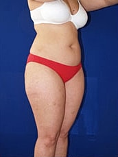 Liposuction Before & After