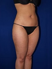 Liposuction Before & After