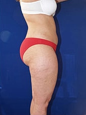 Liposuction Before & After