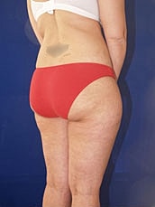 Liposuction Before & After