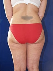 Liposuction Before & After