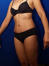 Liposuction Before & After