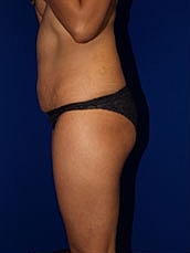Liposuction Before & After