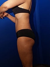 Liposuction Before & After