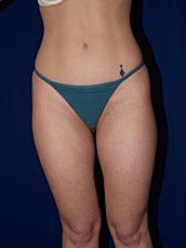 Liposuction Before & After