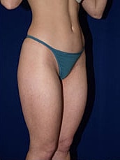 Liposuction Before & After