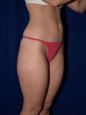 Liposuction Before & After