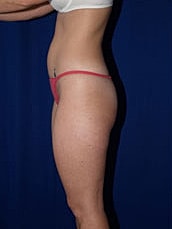 Liposuction Before & After