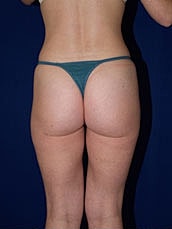 Liposuction Before & After