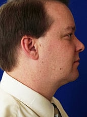 Liposuction Before & After